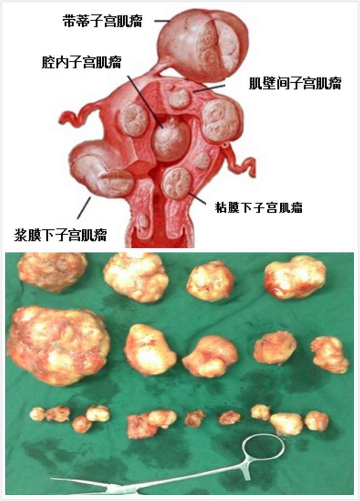 【金夫人健康专题】解读子宫肌瘤